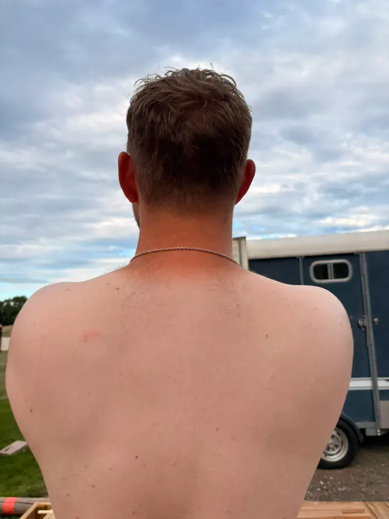 A builder’s tan 😂